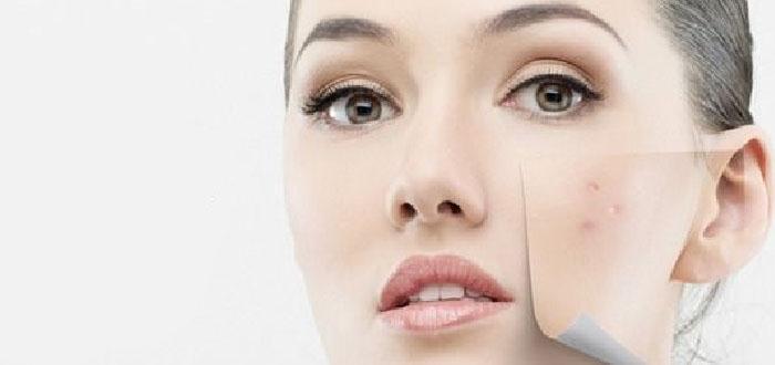 خلطات تخلصك من البثور