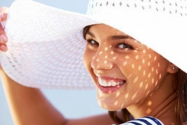 خلطات طبيعية لعلاج حروق الشمس صيفاً